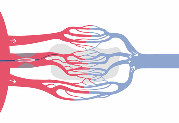 Image 2 of 4: Epicardial flow restored